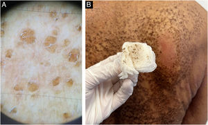 Terra firma-forme dermatosis (TFFD) ‒ (A) Dermoscopic examination and (B) Friction test using 70% isopropyl alcohol.