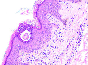 Hematoxylin & eosin, ×40. Areas of orthokeratotic hyperkeratosis with intracorneal spiral formations, hypogranulosis, mild acanthosis, and focal mild papillomatosis.