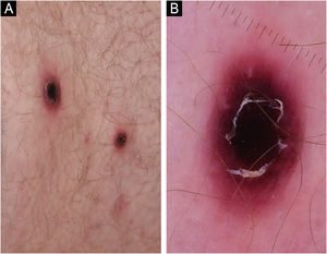 Erythematous papulonodular lesions (A) progressing into necrotic ulcers (B).
