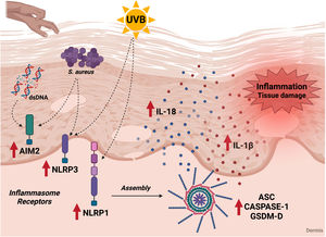 Association of the inflammasome cascade with AD immunopathology. Components of the inflammasome signaling pathway are increased in the skin of AD patients. In the skin of patients, inflammasome receptors can be activated by exposure to ultraviolet radiation, by contact with S. aureus antigens, and by possible DNA molecules released by cell damage. These receptors promote the oligomerization of ASC and caspase-1, leading to the maturation of IL-1β and IL-18, which are also elevated in AD patients. In addition, activation of the inflammasome leads to an increase in GSDM-D and promotion of pyroptosis. The release of pro-inflammatory and cell death cytokines contributes to tissue damage and local and systemic inflammation during the disease. UVB, ultraviolet radiation; S. aureus, Staphylococcus aureus; dsDNA, double stranded DNA. Figure generated with BioRender.