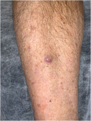 Right pretibial region; a painless, firm, slightly mobile erythematous-violaceous tumor.