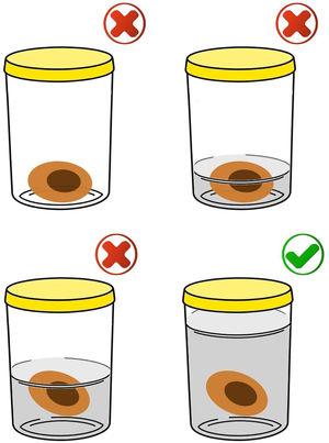 The correct way to store the specimen is using a volume of 10% buffered formalin greater than 10‒20 times the volume of the specimen (bottom right image). It is not acceptable to send the material without formalin, in a volume that does not cover the specimen in its entirety or in a volume slightly greater than the volume of the specimen.