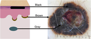 Color variation in melanocytic lesions reflects the location of the melanin pigment in the skin. The schematic drawing shows the correspondence of the colors/tones of melanoma in the dermoscopic examination according to the melanin deposit: black in the stratum corneum, brown in the basal layer of the epidermis, and bluish/gray in the dermis.