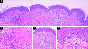 Traumatized nevi are a good example of the need for clinical-pathological correlation. See the panoramic image of a nevus on the thigh of a 44-year-old female patient. The remaining nevus can be seen on the left, the central fibrosis and the dermal inflammatory infiltrate with melanophages on the right (A) Hematoxylin & eosin ×40. In detail, the remaining intradermal nevus and the fibrosis parallel to the direction of the epidermis, Hematoxylin & eosin ×200 (B). In detail, the inflammatory infiltrate with melanophages, Hematoxylin & eosin ×200 (C). Presence of atypical proliferated junctional melanocytes, a common finding in traumatized melanocytic lesions, Hematoxylin & eosin ×400.