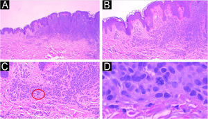 Another example of the importance of anatomical-clinical correlation: intradermal melanocytic nevus removed for aesthetic purposes from a 14-year-old female patient. Panoramic view of the intradermal nevus (A), Hematoxylin & eosin ×40. Melanocytes arranged in nests with maturation to depth (B) Hematoxylin & eosin ×100 and no signs of atypia (C) Hematoxylin & eosin ×200. The presence of atypical deep mitosis in the center of the image, which does not change the diagnosis, Hematoxylin & eosin ×1000.