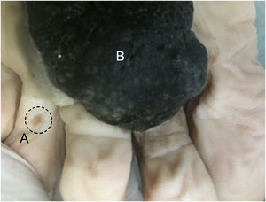 Macroscopic image of acral melanoma with a small discontinuous lesion (A) and a large tumor component (B). The identification of satellites/microsatellites/cutaneous metastases influences staging and can occur through detailed macroscopic examination.