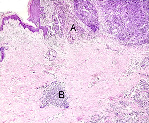 The histological section (Hematoxylin & eosin ×40) shows the primary melanoma in vertical growth (A) and microsatellite (B) in the dermis. The microsatellite is characterized by discontinuous tumor proliferation, adjacent to the main tumor, permeated by normal tissue, without findings of inflammatory infiltrate or fibrosis that could suggest tumor regression.