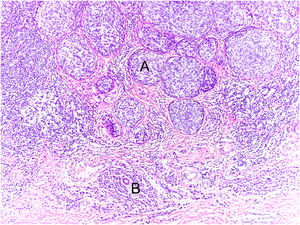 The histological section (Hematoxylin & eosin ×40) shows melanoma (A) associated with intradermal melanocytic nevus (B). The melanoma is characterized by nests of atypical melanocytic cells without signs of maturation and exhibiting moderate nuclear pleomorphism (A). Below (B) small melanocytic cells can be observed, scattered throughout the dermis, exhibiting scarce cytoplasm and no cytological atypia.