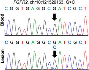 Sanger sequencing validation of the FGFR2 mutation identified by WES in the patient
