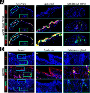 Immunofluorescence staining of the lesional biopsy (A) and healthy control (B). In the lesional skin (A), an uneven distribution of Ki-67-positive cells was observed in the epidermis and sebaceous glands, with higher abundance compared to normal control skin. CK6 was upregulated and CK5 downregulated in the epidermis and peripheral basal cells of the sebaceous glands. Basal and suprabasal keratinocytes showed increased and colocalized expression of FGF22 and FGFR2. In contrast, the sebaceous glands exhibited FGFR2 expression but minimal FGF22. In the healthy control skin (B), there was minimal presence of Ki-67-positive cells or CK6 in the epidermis and sebaceous glands. CK5 was expressed in the epidermis and peripheral basal cells of the sebaceous glands. Basal and suprabasal keratinocytes exhibited no expression of FGF22 or FGFR2. In the peripheral basal cells of the sebaceous glands, FGFR2 expression was observed, with FGF22 absent. Scale bar: 200 μm for overview; 50 μm for the epidermis and sebaceous glands.