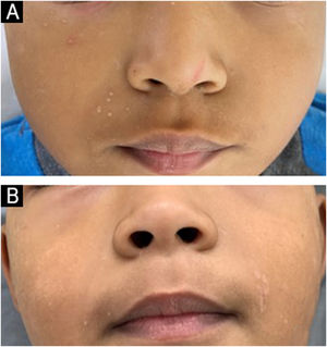 Patient with molluscum contagiosum on the right side of the face treated with imiquimod. (A) Before treatment; (B) Clinical outcome after 28 weeks.