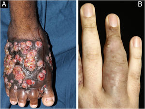 Clinical. (A) Tumor showing fistulae in different stages of evolution located on the dorsum of the right foot. (B) Nodules and fistulae on the fingers.