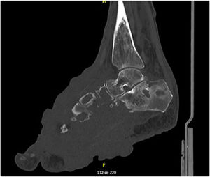 Computed tomography of the right foot showing voluminous expansive and infiltrative solid tissue with extensive bone and soft tissue involvement.