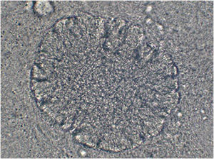 Botryomycosis grain analyzed through direct microscopic examination, showing aggregates of cocci.