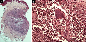 Histopathology. (A) Histological section showing chronic suppurative granulomatous dermatitis containing grain in the deep dermis (Hematoxylin & eosin, ×40). (B) Rounded structures forming a grain, are involved by the Splendore-Hoeppli phenomenon (Hematoxylin & eosin, ×400).