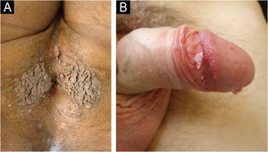 (A) Anal condyloma. (B) Penile condyloma.
