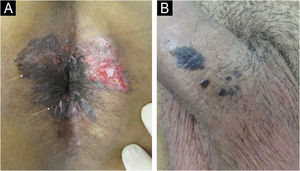 (A) Patient living with HIV using antiretroviral therapy with undetectable VL and CD4 327 cells/mm3 showing concomitant lesions caused by HPV: squamous cell carcinoma (SCC) in situ/Bowen