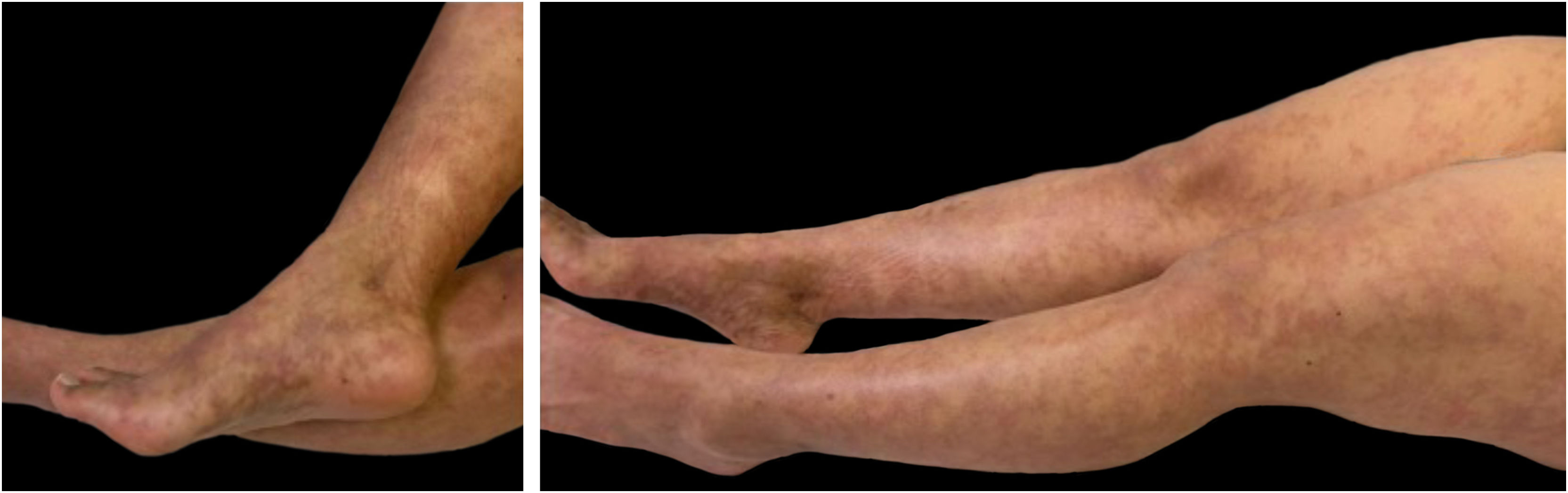 Levidoid Rash Lymphocytic thrombophilic arteritis, an infrequent cause of livedo ...