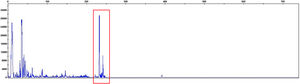 T-cell receptor gene rearrangement analysis show monoclonality with two differently sized gene rearrangements (red box).
