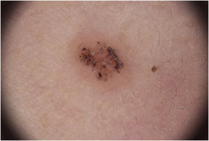 Digital dermoscopy with x20 magnification. Fotofinder System, Bad Birnbach, Germany.