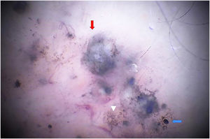 SHD with x180 magnification. The image shows blue ovoid nests at higher magnification (red arrow), rounded blue globules (blue arrow) and irregular pigmented structures (triangle).