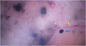 SHD of the same region with x400 magnification. Telangiectasias can be seen at higher magnification, with focus (yellow arrow), surrounded by irregular pigmented structures (triangle) and rounded blue globules (blue arrow).