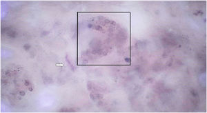 SHD at x400 magnification demonstrates a globule of an intradermal melanocytic nevus. Telangiectasias without focus (white arrow) can be observed.