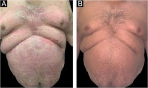 (A) Infiltrative erythematous-scaly plaques on the trunk before Ustekinumab. (B) Ten months after starting ustekinumab, no lesions present.