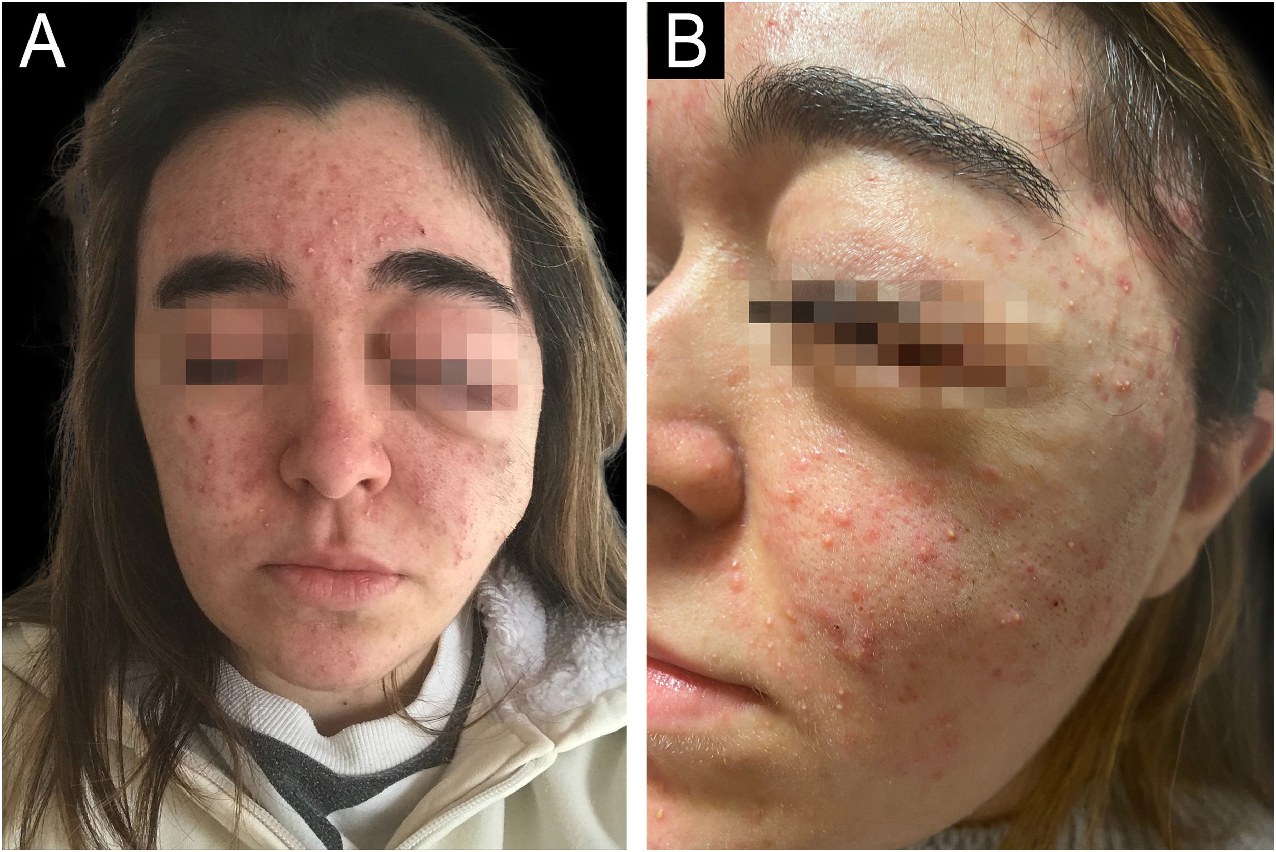 Confluent Rash Aceniform Acneiform rash secondary to trametinib in two patients with ...