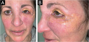 Clinical presentation of the lesions before starting tofacitinib. Yellowish, shiny, and infiltrated plaques located around the eyelids and periocular region bilaterally, with more pronounced involvement in the left eye, where they caused visual restriction. Surrounding erythema around the plaques.