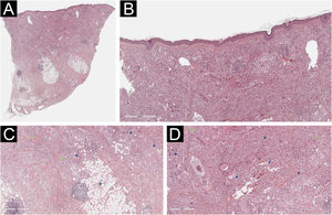 Histological examination of the left lower eyelid lesion (Hematoxylin & eosin; panel A 20×, panel B 80×, panel C 140×, panel D 160×). Histology showed collagenous fibrous tissue in the dermis, interspersed with increased lymphohistiocytic cellularity with abundant foamy histiocytes (blue arrows in panels C and D) and multinucleated giant cells (green arrows in panels C and D).