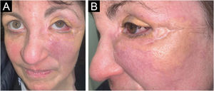 Clinical presentation of the lesions one year after starting tofacitinib. Improvement of the lesions, with a slightly smaller diameter, less active border, and improvement in left visual restriction. Similarly, upon palpation, the lesions felt less infiltrated.
