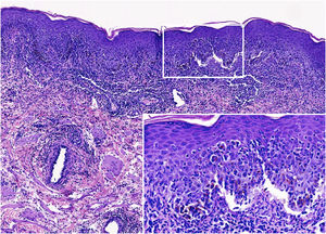 Histological images. Scrotal lesion showing a dense inflammatory infiltrate in the superficial and mid-dermis, predominantly composed of lymphocytes and polymorphonuclear cells. Interface damage is evident, with subepidermal splitting and apoptotic keratinocytes (Hematoxylin & eosin; ×160 and ×800 – inset).