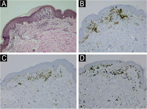 Histology of ATLL lesion showing exocytosis of lymphocytes with aggregates of atypical cells on the epidermis, and perivascular atypical lymphocytes on the superficial dermis (A, Hematoxylin & eosin, ×100); CD4 positivity (B, ×100); partial loss of CD7 (C, ×100); Ki-67 of 60% (D, ×100).