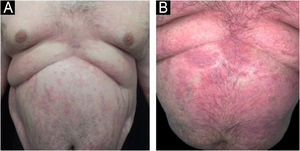 (A) Plaque psoriasis and striae on the trunk before acitretin. (B) Pustular eruption after phototherapy.