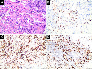 Histopathological findings. A. Hematoxylin & eosin, ×100, showing irregular slit-like vascular spaces lined by endothelial cells and spindle cell proliferation. B. (Immunohistochemical, ×100), positive for Human Herpesvirus type-8 (HHV-8), C. CD34, and D. ETS-Related Gene (ERG).