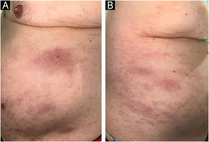 Morphea plaques in the patient. (A and B) Oval erythematous-violaceous plaques on the left and right flanks.