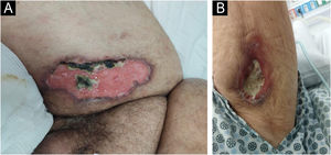 (A) Shallow ulcer in the right thigh region with necrosis of graft tissue. (B) Ulcer in the proximal lower region of the left arm.