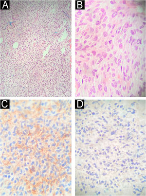 (A and B) Excisional fragment of a right hip disarticulation product stained with hematoxylin and eosin, ×100 and ×400, respectively, demonstrating proliferation of spindle cells with high cellularity, mitotic index of 8 per 2 mm2, moderate atypia, forming fascicles with variable, narrow elongations, in fibrillar and edematous stroma. (C) Immunohistochemistry of the specimen weakly positive for CD34. (D) Immunohistochemistry of the specimen negative for S100.