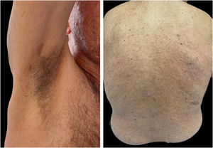 Presence of multiple superficial cutaneous neurofibromas, axillary freckles and multiple café-au-lait spots.