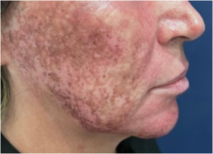 Abnormal healing one month after phenol-croton 35%/1.2% peeling in a patient with frontal fibrosing alopecia. Photo: Dr. Felipe Ribeiro.