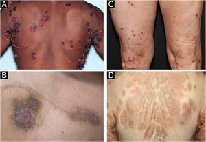 Clinical manifestations of classic BP with tense blisters (A) and non-bullous BP forms, including eczematous (B), prurigo-like (C), and urticariform (D).