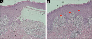 Skin biopsy: Histopathological findings of (A) subepidermal blistering with eosinophils in the classic BP form (Hematoxylin & eosin, ×4), and (B) presence of eosinophilic spongiosis (intraepidermal eosinophils within areas of spongiosis) in a case of non-bullous form (Hematoxylin & eosin, ×4).