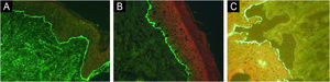 Immunofluorescence findings with DIF demonstrating IgG (A) and C3 (B) deposition at the BMZ, and IIF with salt-split technique demonstrating IgG deposition at epidermal side of the detachment (C).