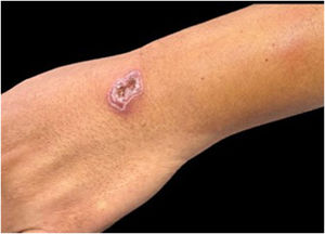 Patient with the fixed cutaneous form of sporotrichosis.