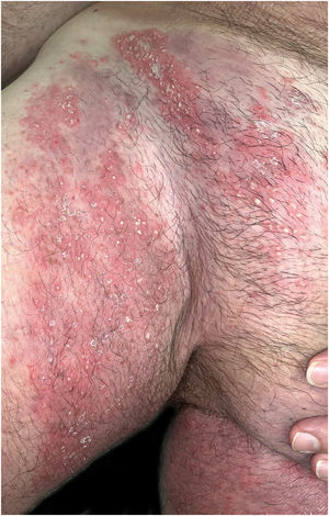Clinical presentation of inguinal lesions before initiation of secukinumab. Erythematous papules and plaques with overlying peripheral pustules.