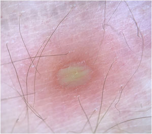 Dermoscopic presentation of the lesions. Pustule with a slightly erythematous base.