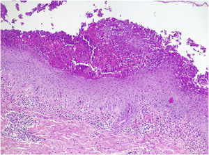 Histopathological presentation of the lesions (Haematoxylin & eosin 100×). Moderate perivascular and interstitial inflammatory infiltrate in the dermis, predominantly polymorphonuclear, and in the epidermis minimal spongiosis, parakeratosis and clusters of polymorphonuclear leukocytes forming subcorneal microabscesses. There were no bacterial colonies, acantholysis, papillary atrophy, suprapapillary atrophy or confluent parakeratosis.