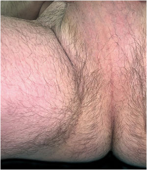 Clinical presentation of the inguinal lesions after 18 months of secukinumab treatment. Complete resolution of the lesions.