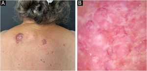Clinical and dermoscopic photographs of the lesions. (A) Two violaceous papular plaques on the upper back, with surrounding papules of the same color. (B) White structures and telangiectasias with a pink background on dermoscopy.
